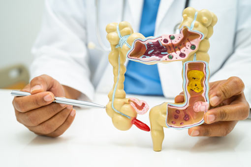 prevención cáncer de colon