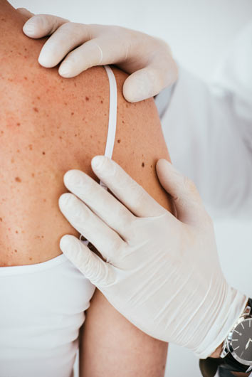 Persona con guantes de látex blancos examinando los lunares de la espalda de una mujer