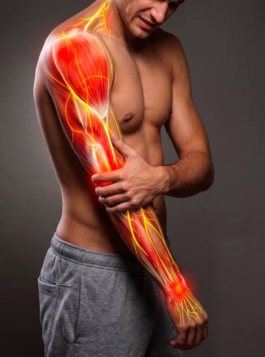 Hombre sujetándose el brazo con expresión de dolor, con una ilustración anatómica superpuesta que muestra los músculos en color rojo y los nervios brillando en amarillo, indicando una lesión médica.