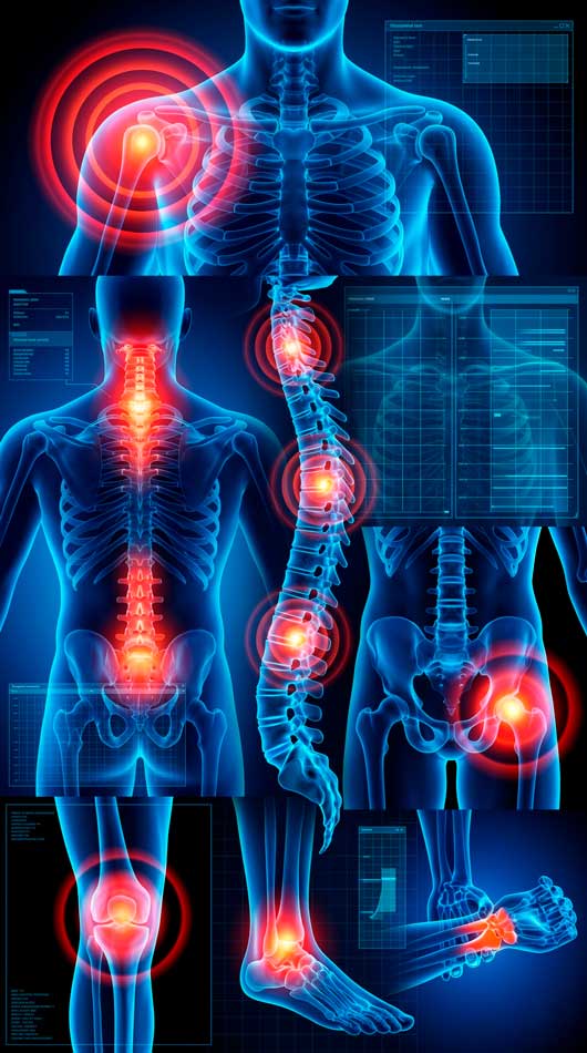Un montaje de escaneos médicos digitales azul traslúcido del sistema esquelético humano, con áreas de dolor resaltadas por círculos rojos brillantes en el hombro derecho, la columna vertebral (cervical y lumbar), la cadera derecha, la rodilla, el tobillo y la muñeca/mano. Muestra puntos de dolor musculoesquelético comunes